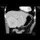 Focal nodular hyperplasia, FNH, flow rate of contrast: CT - Computed tomography